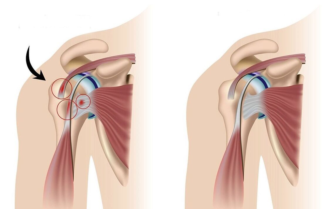 Results of shoulder treatment with Arthro Lab