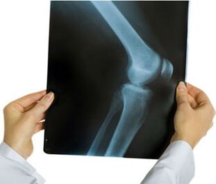 X-ray for knee osteoarthritis